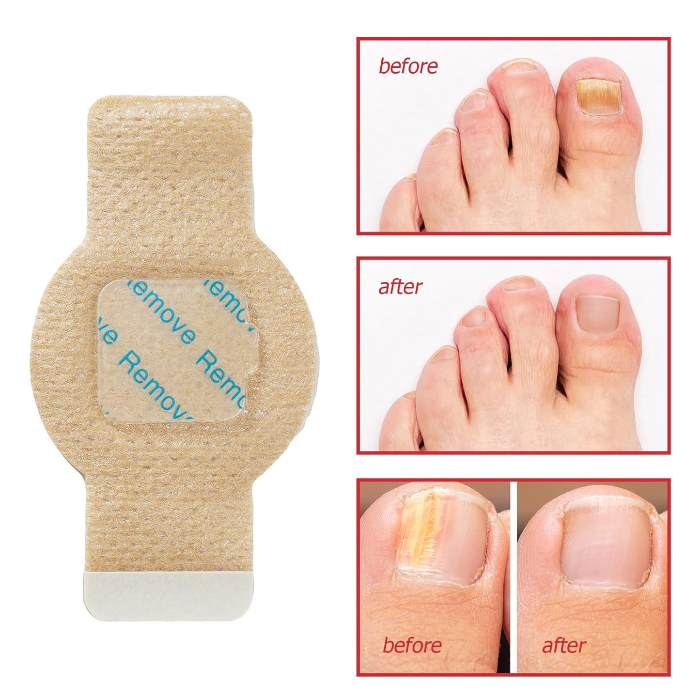 Eliminate Toenail Fungus Overnight While You Sleep