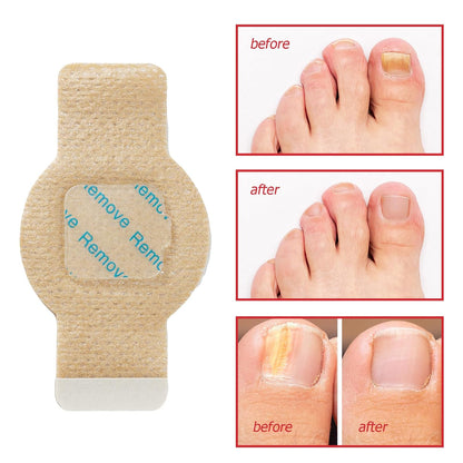 Eliminate Toenail Fungus Overnight While You Sleep