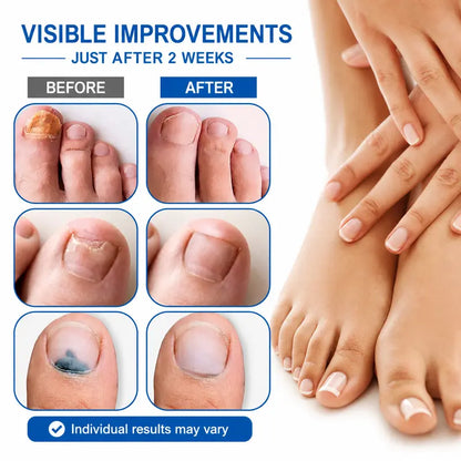 Get Clear, Healthy Nails in Just 7 Days – 100% Plant-Based Extra Strength Liquid