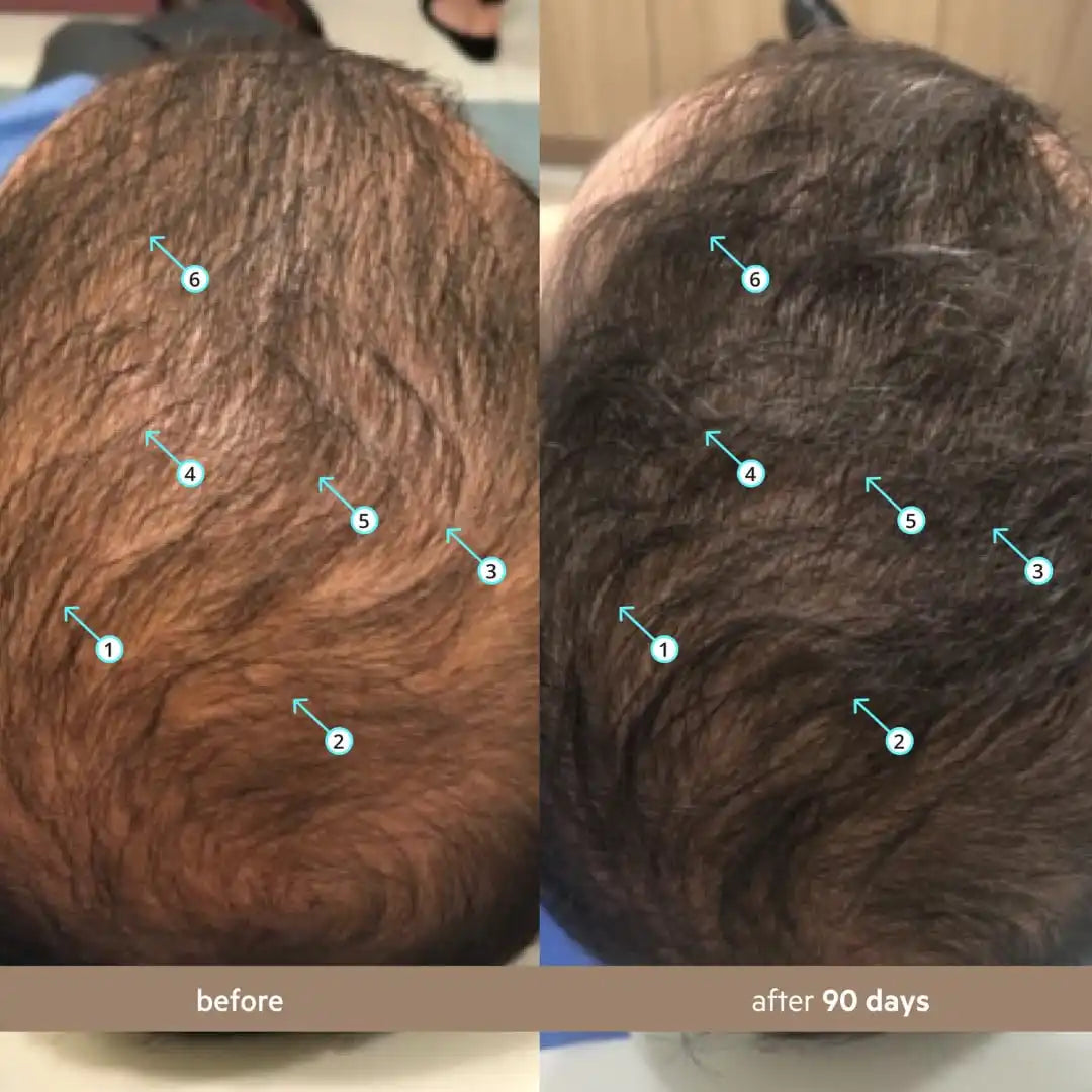 Men’s Hair Density Serum – Thicker Hair in 90 Days
